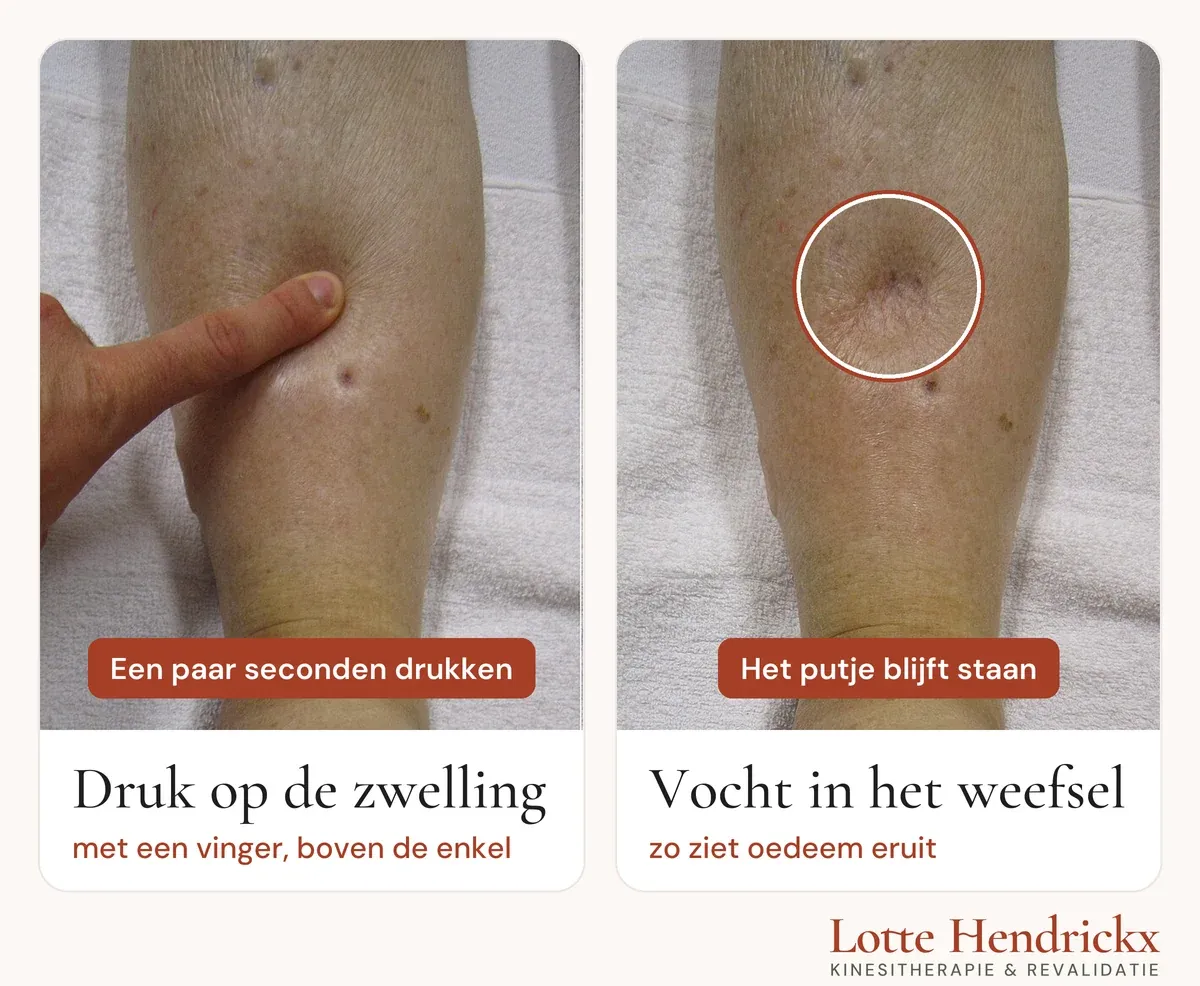 Links drukt een vinger enkele seconden op een gezwollen onderbeen. Rechts is de vinger weg en blijft er een duidelijk putje in de huid staan, omcirkeld.