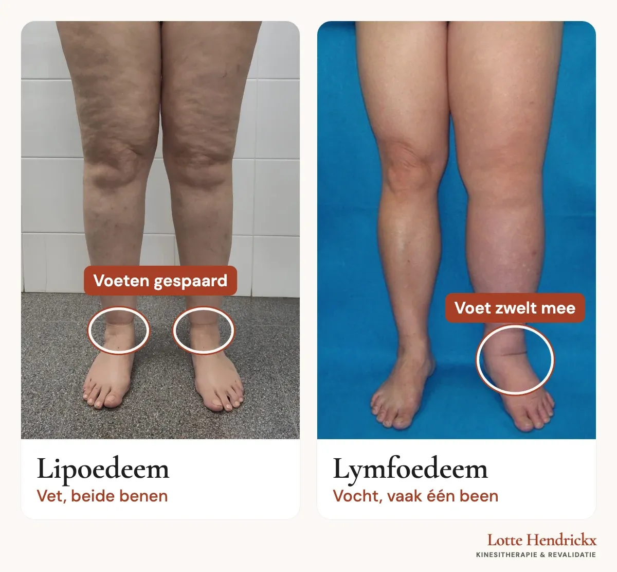 Links de benen van een vrouw met lipoedeem: beide benen zijn symmetrisch dik tot net boven de enkel, de voeten zijn slank. Rechts lymfoedeem van het linkerbeen: één been is gezwollen, de voet en de enkel doen mee.